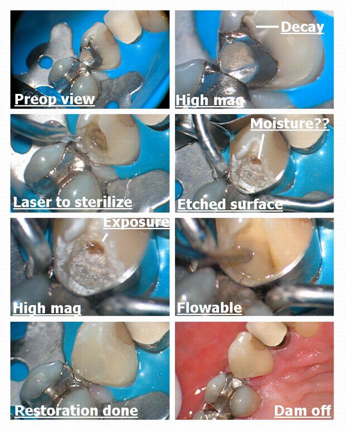 Resize of Pulp exposure on tooth.jpg